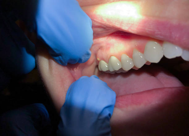Best Cracked Tooth Emergency Dentist  in Lahoma City, OK