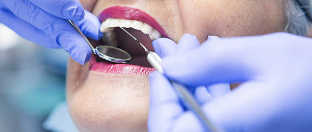 Teeth Whitening in OK